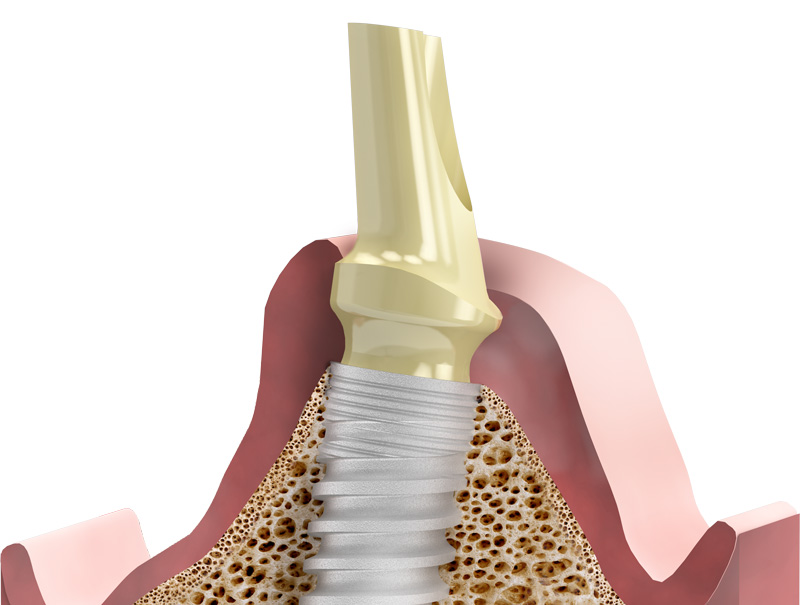 Enhanced, BestSelling SEVEN Implant is Launched MIS Dental Implants